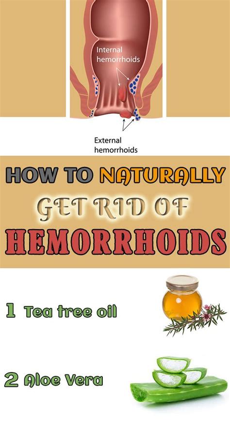 How to naturally get rid of hemorrhoids 10 home remedies Discover how to cure hemorrhoids ...