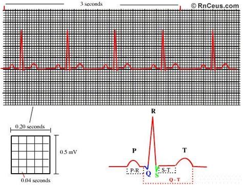 ECG Paper 101: Everything You Need to Know About ECG Paper | Panda ...