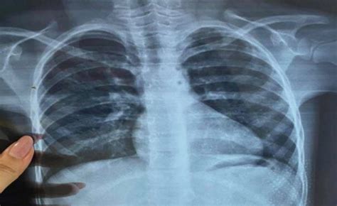 1. X-ray of a patient with TOF | Download Scientific Diagram