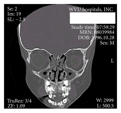 Coronal CT scan of the sinuses demonstrating significant disease in ...