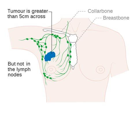 Stage 2 Breast Cancer Diagnosis - XpertPatient