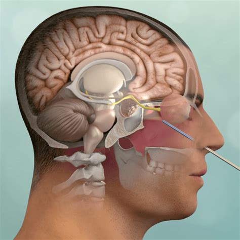 Olfactory Neuroblastoma | Pacific Brain Tumor Center