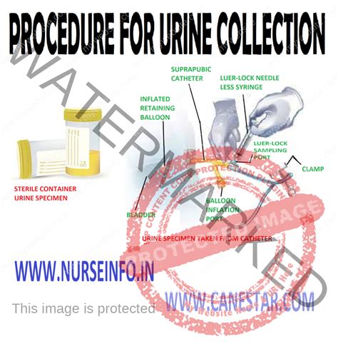 How To Collect A Urine Specimen From A Suprapubic Catheter at Theresa ...