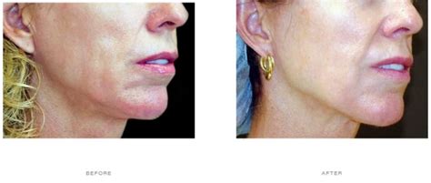 Thermage Before and After | Thermage Skin Tightening | Thermage near me - London ...