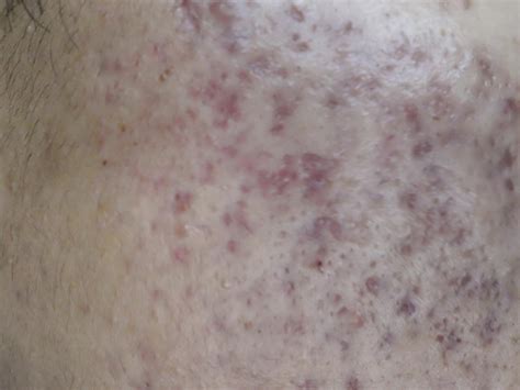 Help! Very Severe Acne Scars / Hyperpigmentation / Redness ...