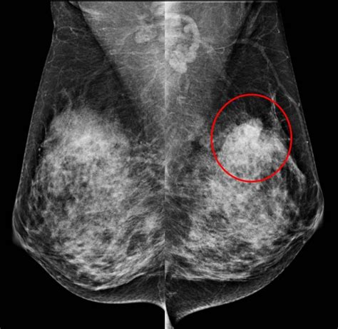 Mammogram: focal asymmetry – Radiology Cases