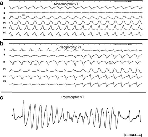 Difference between monomorphic and polymorphic ventricular tachycardia ...