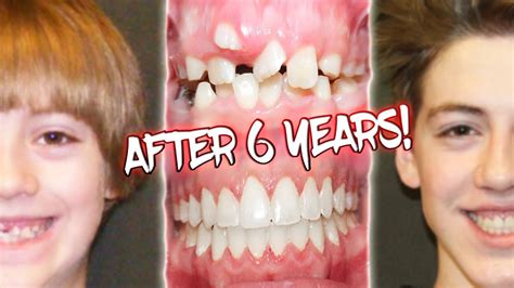 6 YEARS OF BRACES BEFORE AND AFTER TRANSFORMATION! - YouTube