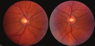 Centrocecal Scotoma Symptoms, Causes, Treatment