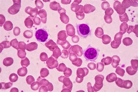 Causes and Treatment of Low Lymphocyte Count [Lymphocytopenia]