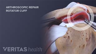 Shoulder Decompression Surgery: Recovery, Risks, and Complications