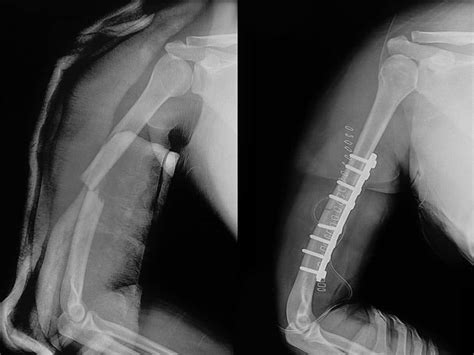 Dr Terence Moopanar | Shoulder fracture management