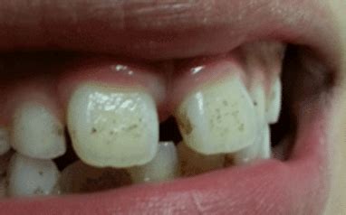 Black Spots on Teeth, Tiny, near Gums, Line, no Cavities, Brown, Stains, form Smoking, with ...