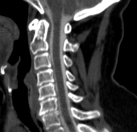 What Is Ct Myelography Bone And Spine - vrogue.co