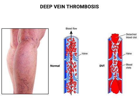 Deep Venous Thrombosis (DVT): Symptoms, Diagnosis, And, 46% OFF