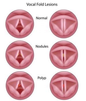 Vocal Cord Damage: What are the Causes?