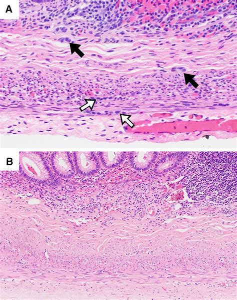 Appendix histology in infants: A Normal appendix of a neonate showing ...