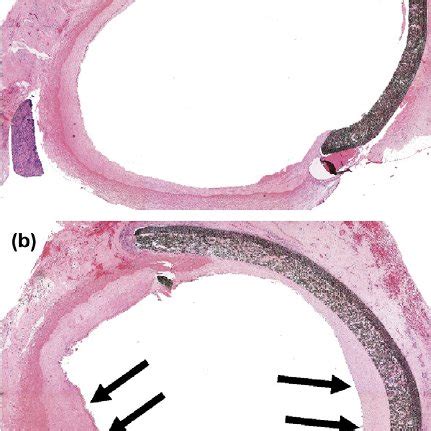 Area of intimal hyperplasia in bypass grafts of un- treated and ...