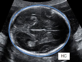 Ultrasound scan—fetal growth scan - Bhubaneswar Fetal Medicine Centre