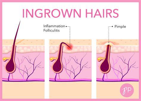 How To Treat & Prevent Ingrown Hairs - The Pretty Pimple