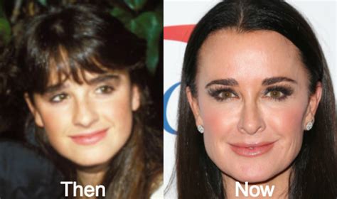 Kyle Richards Plastic Surgery Before and After Photos