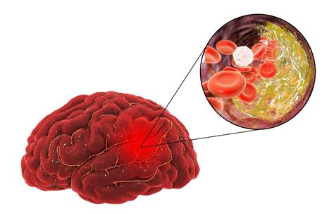 New anticoagulant asundexian prevents recurrent ischaemic stroke ...