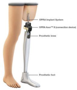 What You Need to Know About Osseointegration | Niagara Prosthetics