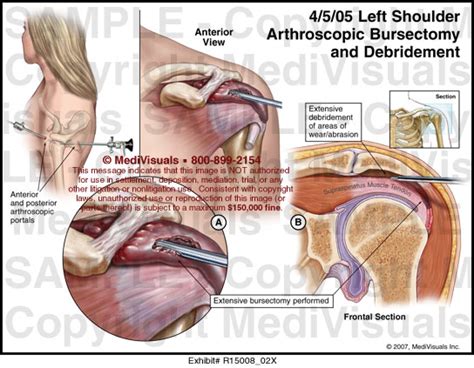 Left Shoulder Arthroscopic Bursectomy and Debridement