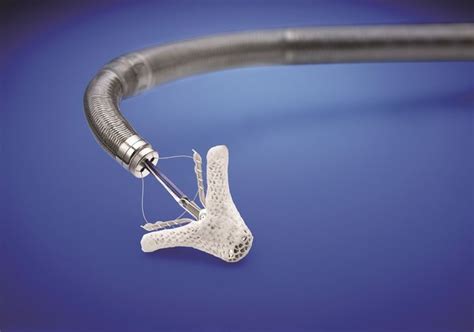 Transcatheter Mitral Valve Repair Device: The device is delivered by a ...