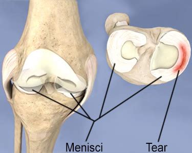 Meniscus Surgery: Trimming, Repair & Meniscectomy | HSS