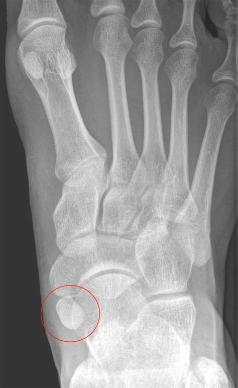 Foot x-rays