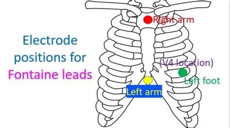 Epsilon Wave – All About Cardiovascular System and Disorders