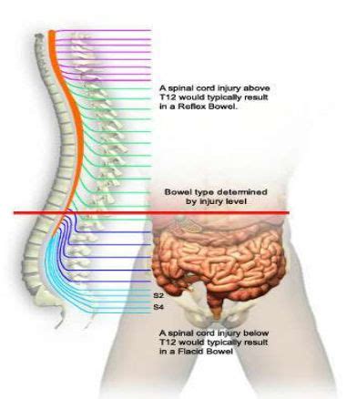 Bowel movement of a neurogenic bowel works in a different way after ...