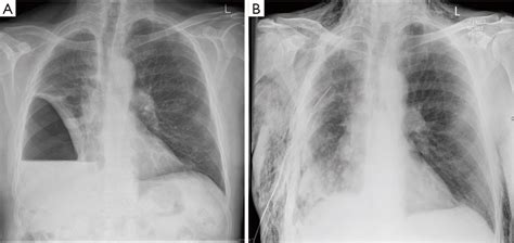 Extended pleurectomy decortication: the current role - Bilancia - Translational Lung Cancer Research