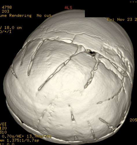 Pfeiffer syndrome type II - NeuroRad911