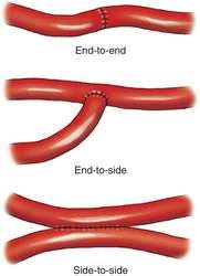 Anastomosis | definition of anastomosis by Medical dictionary