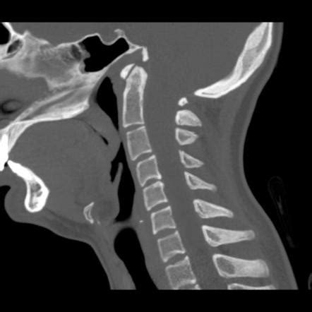 Chamberlain line | Radiology Reference Article | Radiopaedia.org