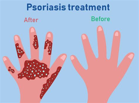 Stages of psoriasis formation. Treatment of psoriasis before and after 6426592 Vector Art at ...