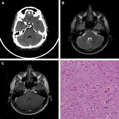 Posterior Fossa Tumor Causes Symptoms Treatment | SexiezPicz Web Porn