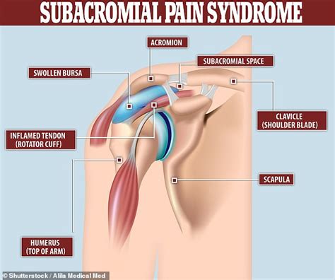 Most common type of surgery for shoulder pain 'does not work' - Worlds ...