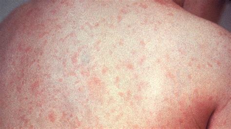 Five things to know about German measles | CTV News