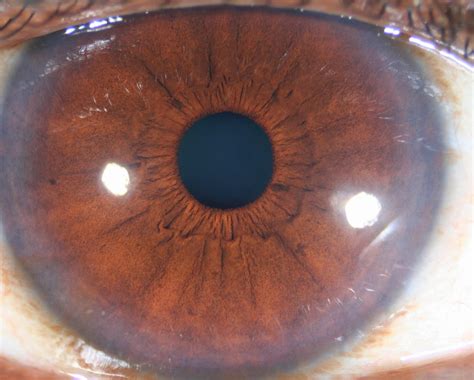 Modern & Multidimensional Iridology: Linking the IPB, Pupil & Pupillary Zone in MMI Levels