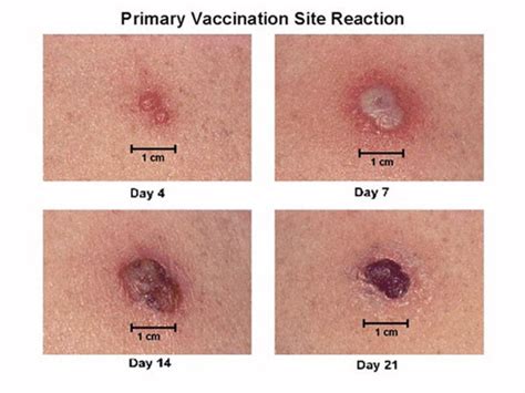 Smallpox - Symptoms, Vaccine, Diangosis, Treatment