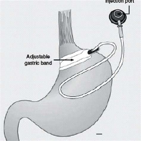 Adjustable gastric banding | Download Scientific Diagram