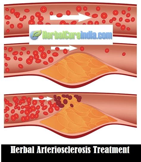 Herbal Arteriosclerosis Treatment | by Lee Jhonson | Medium