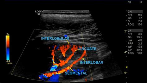 Renal Artery Doppler – Sonographic Tendencies Cardiac Sonography, Sonography Student, Superior ...