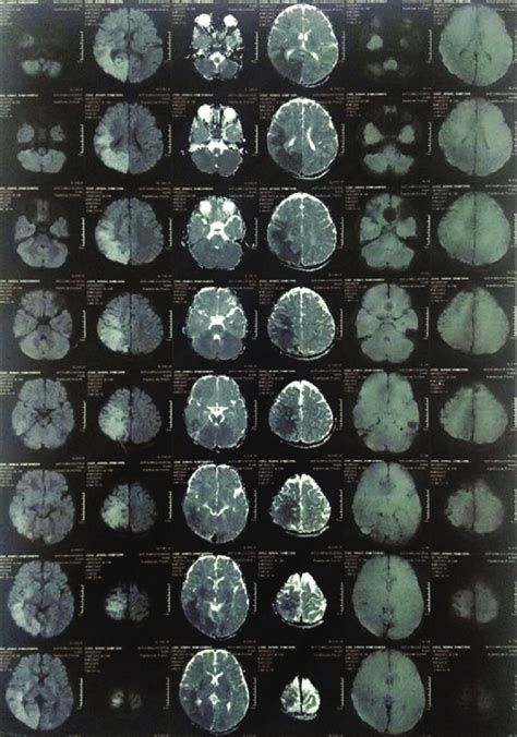 MRI diffusion gradient image showing restricted diffusion involving... | Download Scientific Diagram