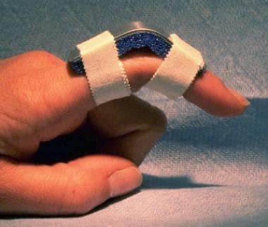 Jammed Finger Treatment & Management: Acute Phase, Return to Play