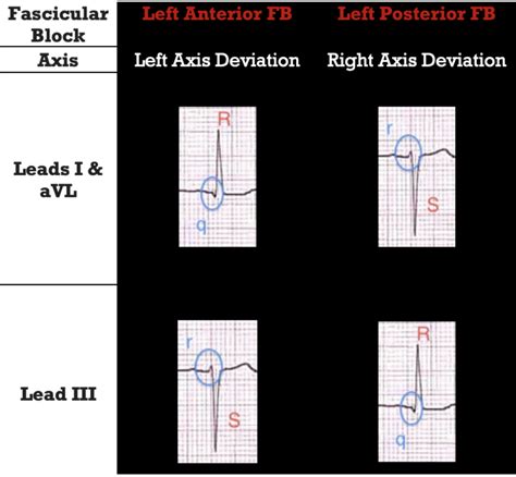 LEFT ANTERIOR FASCICULAR BLOCK – ECG Weekly