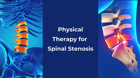 Physical Therapy for Spinal Stenosis-Mangiarelli Rehabilitation